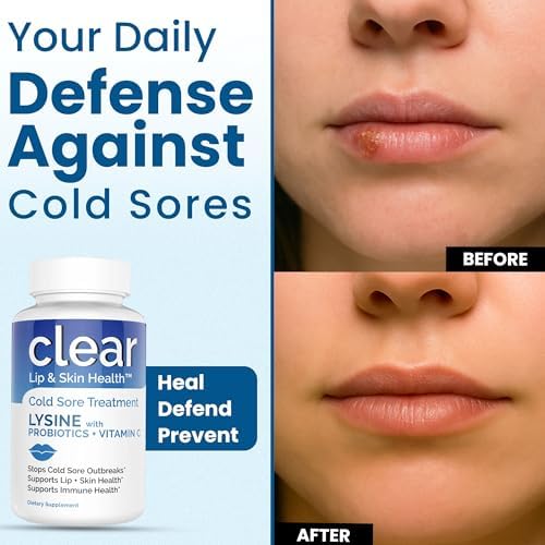 Tratamiento de Herpes Labial con Lisina, Pre-Probióticos y Vitamina C | Suministro para 1 Mes | Cápsulas Supercargadas de Lisina con Rhamnosus y - imagen 5