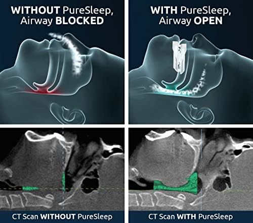 PureSleep, el Original Dispositivo Antisnore y la Solución #1 en el Mundo - imagen 3