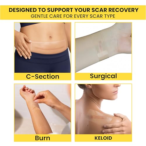 solución para cicatrices de abdominoplastia